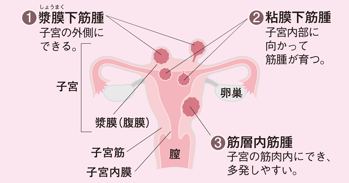 子宮内膜症 子宮筋腫 ホルモン剤で悪化を防ぐ選択肢も 2ページ目 日経xwoman